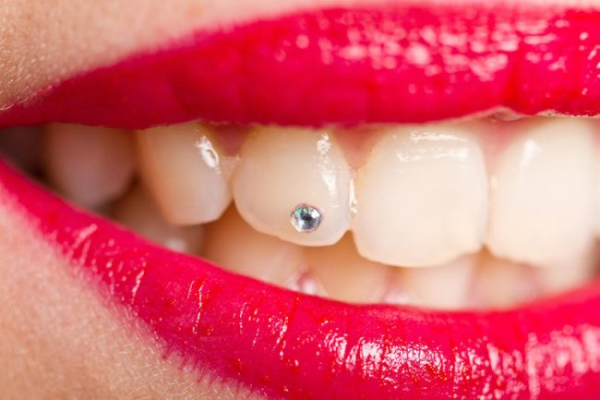 Дентальна інкрустація. Як привернути увагу до своєї посмішки?